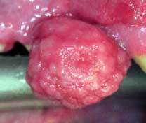 Oral Neoplasia