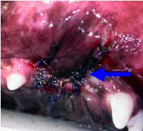 Fistula repaired via flap surgery