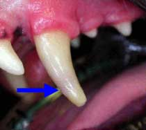 Discolored and nonvital tooth from pulpal hemorrhage resulting from tooth trauma