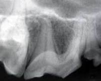 Fractured maxillary carnassial tooth