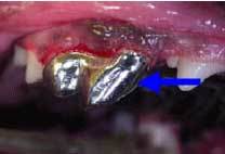 Restorative metal crown applied to fractured tooth