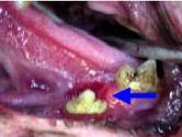 Mandibular fracture