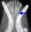 Pathological mandibular fracturefrom advanced periodontitis