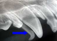 Retained primary canine tooth