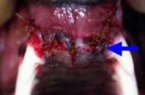 Involved maxillary incisors extracted