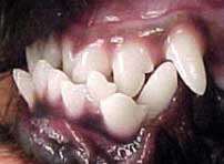 Class 3 malocclusion