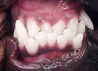 Class 3 malocclusion