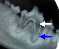 immature pulp cavity indicating tooth death at younger age