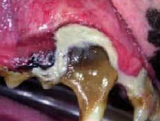 Advanced periodontal disease, stage 4