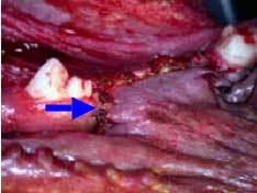 Post extraction of diseased tooth